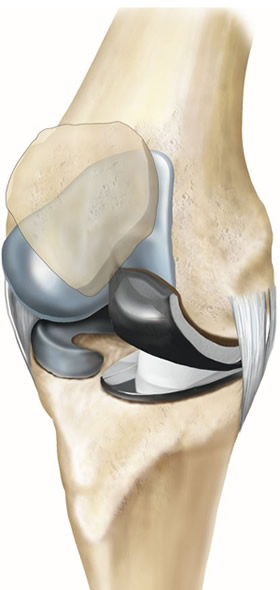 Partial Knee Replacement Diagram